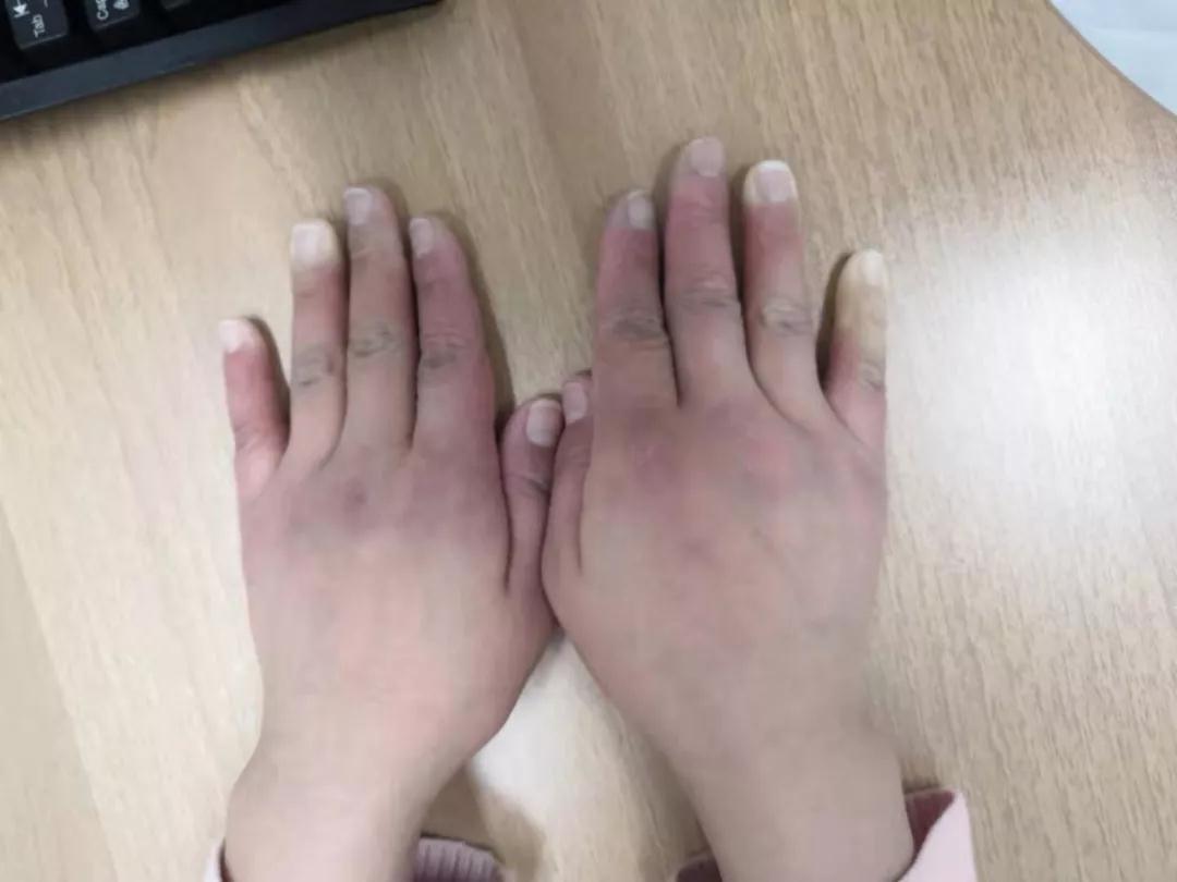 “手指、腳趾發(fā)白、發(fā)紫……”這些“小毛病”千萬(wàn)別大意