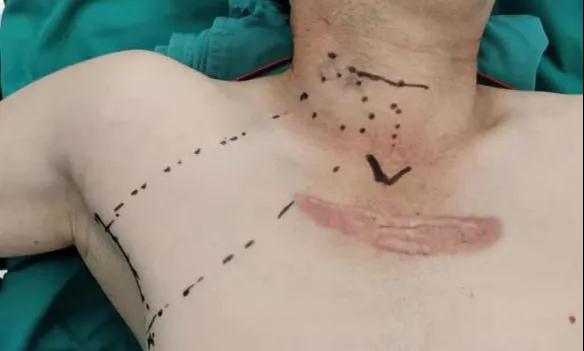 術(shù)后傷口可以“隱身”嗎？