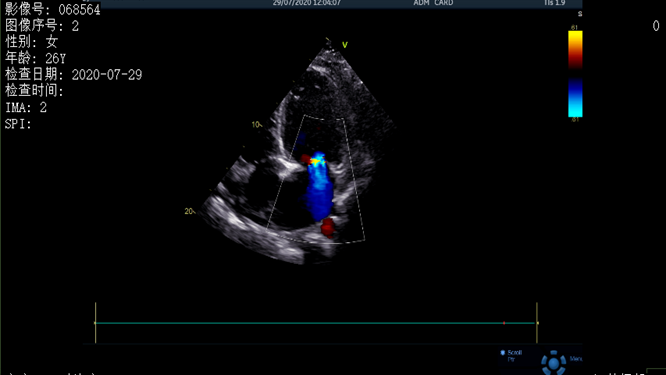 心電圖異常，心臟卻沒事，罪魁禍首是……