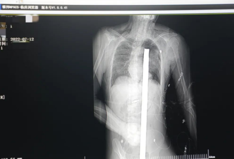 1.2米長的鋼筋貫穿男子胸腹！情況極度危險......