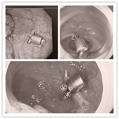 消化病醫(yī)院內(nèi)外科聯(lián)合開(kāi)展3例“磁環(huán)預(yù)標(biāo)記輔助腹腔鏡結(jié)、直腸癌根治術(shù)”