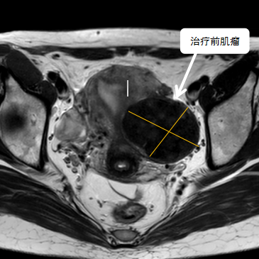 保子宮、保留生育功能—磁波刀治療子宮肌瘤